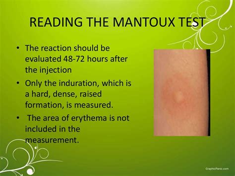 mt test positive images|Mantoux Test: Uses, Procedure, Normal Range and Test Results.